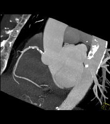 Calcified Plaque in Right Coronary Artery (RCA) - CTisus CT Scan