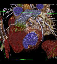 Calcified Plaque in Right Coronary Artery (RCA) - CTisus CT Scan