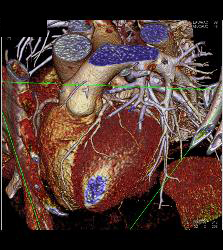 Calcified Plaque in Right Coronary Artery (RCA) - CTisus CT Scan