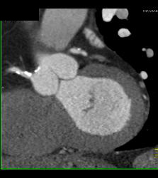 Calcified Plaque in Right Coronary Artery (RCA) - CTisus CT Scan