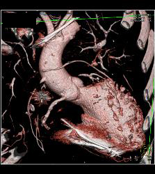 Venous Bypass Graft With Different Renderings - CTisus CT Scan