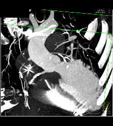 Venous Bypass Graft With Different Renderings - CTisus CT Scan