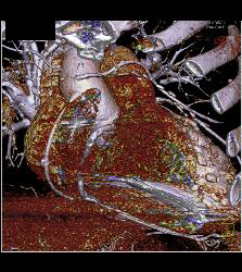 Venous Bypass Graft With Different Renderings - CTisus CT Scan