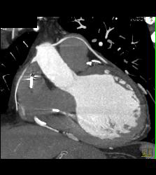 Venous Bypass Graft With Different Renderings - CTisus CT Scan