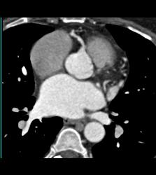 CCTA- Left Anterior Descending Coronary Artery (LAD) and Right Coronary Artery (RCA) Disease - CTisus CT Scan