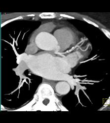 CCTA - Left Anterior Descending Coronary Artery (LAD) and Right Coronary Artery (RCA) Disease - CTisus CT Scan