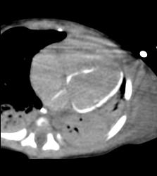 Myocardial Calcification in An Infant. Patient Died - CTisus CT Scan