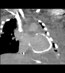 Myocardial Calcification in An Infant. Patient Died - CTisus CT Scan