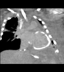 Myocardial Calcification in An Infant. Patient Died - CTisus CT Scan