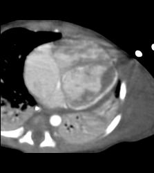 Myocardial Calcification in An Infant. Patient Died - CTisus CT Scan