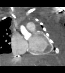 Myocardial Calcification in An Infant. Patient Died - CTisus CT Scan