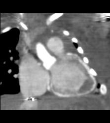 Myocardial Calcification in An Infant. Patient Died - CTisus CT Scan