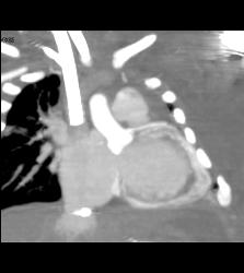 Myocardial Calcification in An Infant. Patient Died - CTisus CT Scan