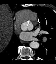 Bicuspid Valve With Calcification - CTisus CT Scan