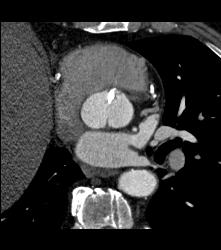 Bicuspid Valve With Calcification - CTisus CT Scan