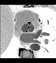 Bicuspid Valve With Calcification - CTisus CT Scan