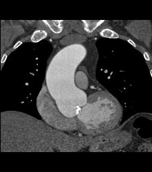 Bicuspid Valve With Calcification - CTisus CT Scan