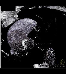 Bicuspid Valve With Calcification - CTisus CT Scan