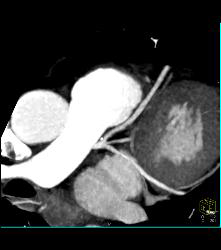 Trifurcation of Left Main Coronary Artery - CTisus CT Scan