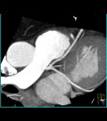 Trifurcation of Left Main Coronary Artery - CTisus CT Scan