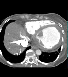 Poor Cardiac Function With IVC Reflux - CTisus CT Scan