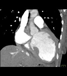 Poor Cardiac Function With IVC Reflux - CTisus CT Scan