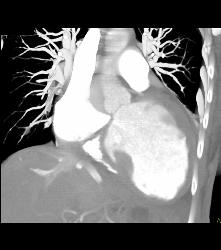 Poor Cardiac Function With IVC Reflux - CTisus CT Scan