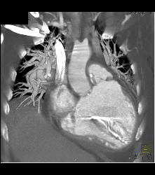 Poor Cardiac Function With IVC Reflux - CTisus CT Scan