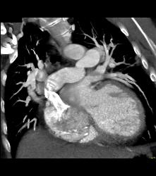 Poor Cardiac Function With IVC Reflux - CTisus CT Scan