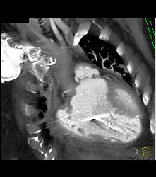 Poor Cardiac Function With IVC Reflux - CTisus CT Scan