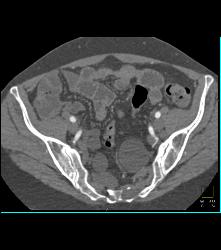 Marfan Syndrome With Aortic Dissection and Repair With Dural Ectasia. Reimplant of Left Coronary Artery Seen - CTisus CT Scan