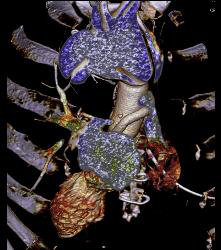 Marfan Syndrome With Aortic Dissection and Repair With Dural Ectasia. Reimplant of Left Coronary Artery Seen - CTisus CT Scan