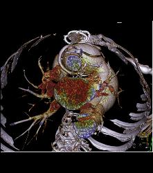 Marfan Syndrome With Aortic Dissection and Repair With Dural Ectasia. Reimplant of Left Coronary Artery Seen - CTisus CT Scan