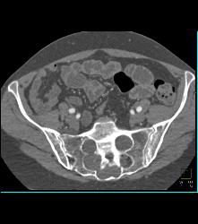 Marfan Syndrome With Aortic Dissection and Repair With Dural Ectasia. Reimplant of Left Coronary Artery Seen - CTisus CT Scan