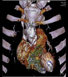 Marfan Syndrome With Aortic Dissection and Repair With Dural Ectasia. Reimplant of Left Coronary Artery Seen - CTisus CT Scan