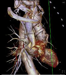 Marfan Syndrome With Aortic Dissection and Repair With Dural Ectasia. Reimplant of Left Coronary Artery Seen - CTisus CT Scan