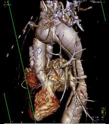 Marfan Syndrome With Aortic Dissection and Repair With Dural Ectasia. Reimplant of Left Coronary Artery Seen - CTisus CT Scan