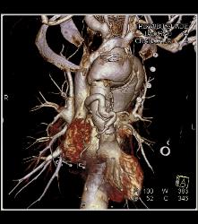 Marfan Syndrome With Aortic Dissection and Repair With Dural Ectasia. Reimplant of Left Coronary Artery Seen - CTisus CT Scan