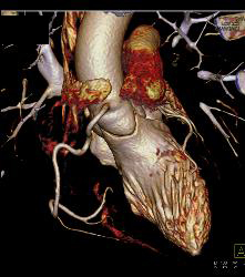 Marfan Syndrome With Aortic Dissection and Repair With Dural Ectasia. Reimplant of Left Coronary Artery Seen - CTisus CT Scan