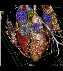 Marfan Syndrome With Aortic Dissection and Repair With Dural Ectasia. Reimplant of Left Coronary Artery Seen - CTisus CT Scan