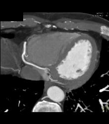 Normal RCA - CTisus CT Scan