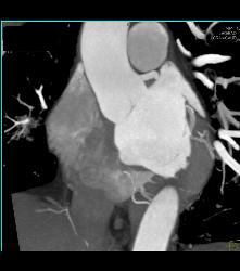 Normal RCA - CTisus CT Scan