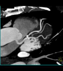 Calcified Plaque in Left Anterior Descending Coronary Artery (LAD) and Circumflex - CTisus CT Scan