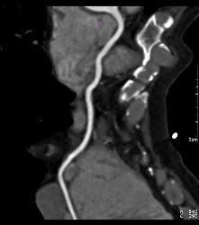 Minimal RCA Plaque - CTisus CT Scan