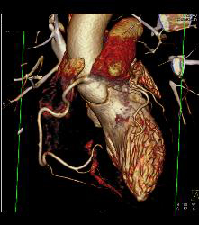 Minimal RCA Plaque - CTisus CT Scan