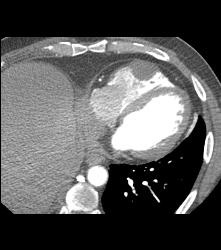 Metastases to the Right Ventricle and Atrium With Renal Mass - CTisus CT Scan