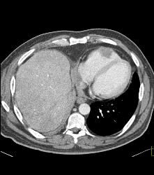 Metastases to the Right Ventricle and Atrium With Renal Mass - CTisus CT Scan