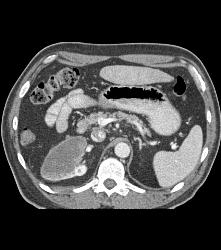 Metastases to the Right Ventricle and Atrium With Renal Mass - CTisus CT Scan