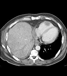 Metastases to the Right Ventricle and Atrium With Renal Mass - CTisus CT Scan