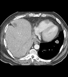 Metastases to the Right Ventricle and Atrium With Renal Mass - CTisus CT Scan